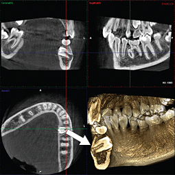 埋伏歯の診断 CT画像