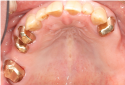 コーヌス義歯の説明画像